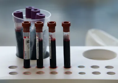 img of California's Lifeline to Sickle Cell Patients Is Dangling. Cutting It Would Be a Catastrophic Failure.