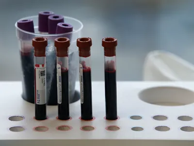 img of California's Lifeline to Sickle Cell Patients Is Dangling. Cutting It Would Be a Catastrophic Failure.